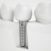 implant dentistry