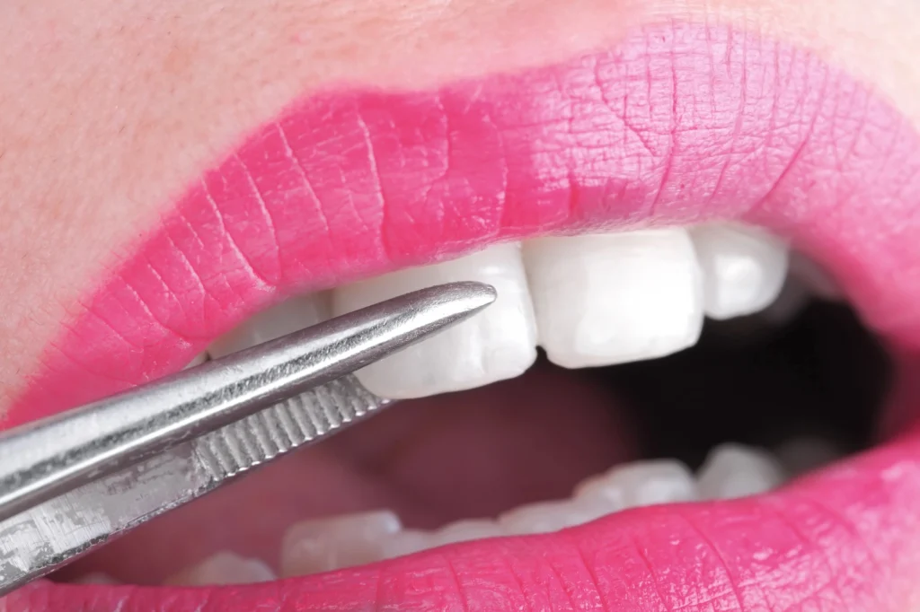 close-up-of-a-dental-tool-touching-teeth-while-applying-veneers-in-Cary